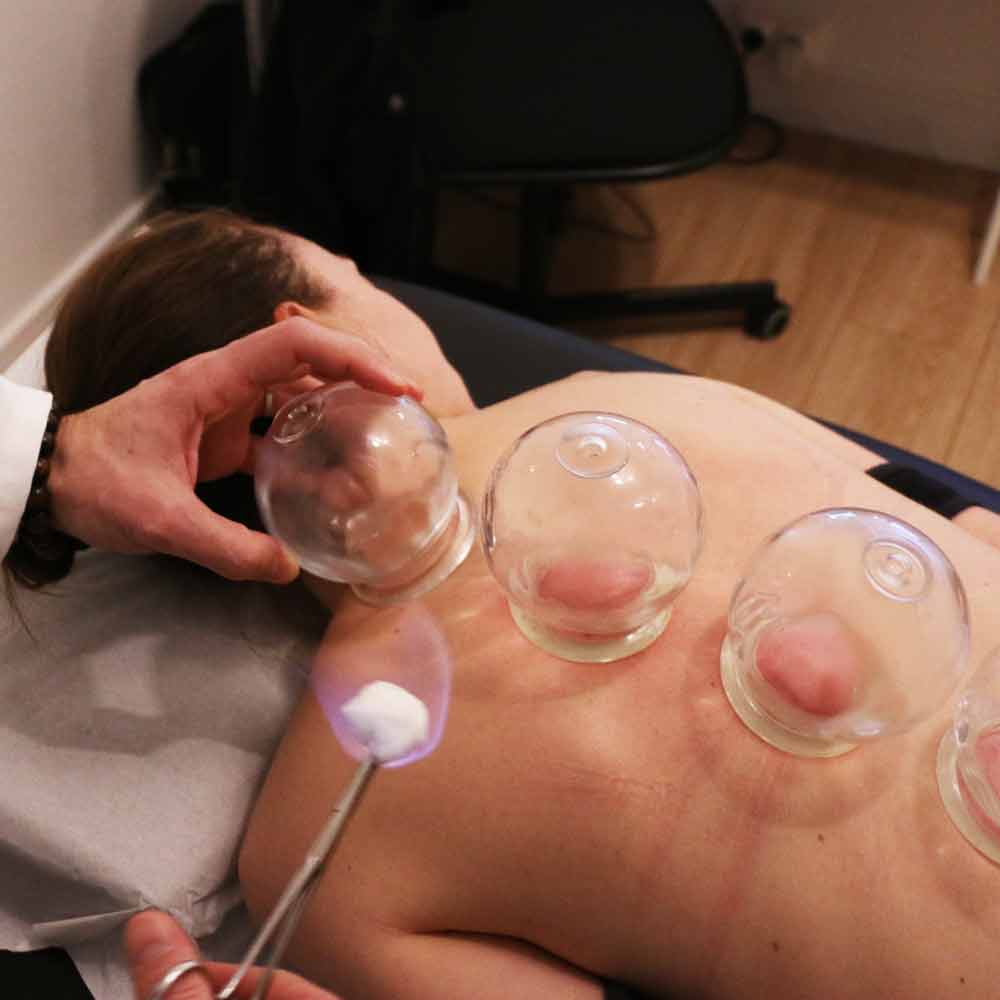 cupping toulouse médecine chinoise