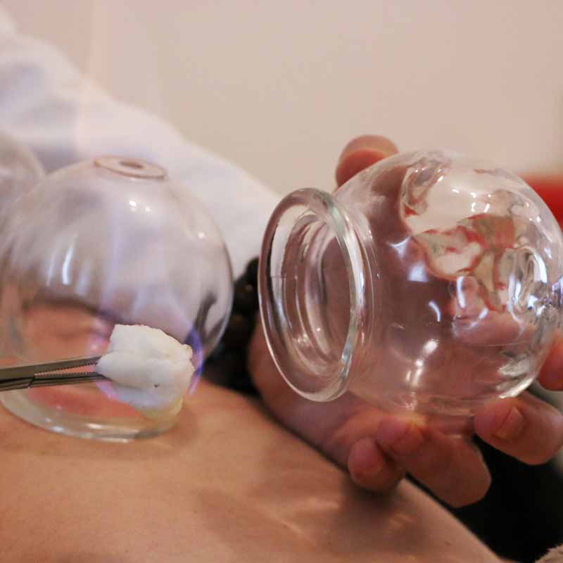 cupping ventouses médecine chinoise toulouse
